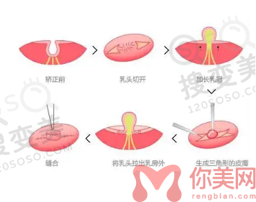 乳头凹陷矫正 乳头凹陷矫正