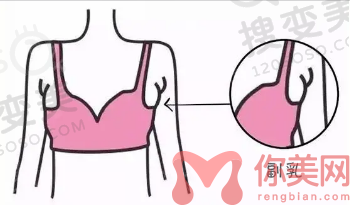 副乳吸脂