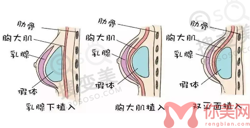 **隆胸手术**