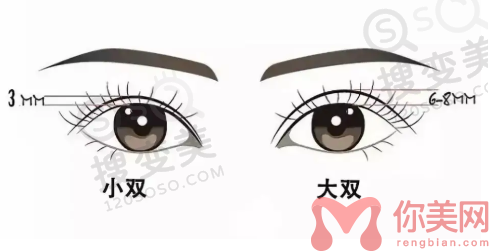 双眼皮