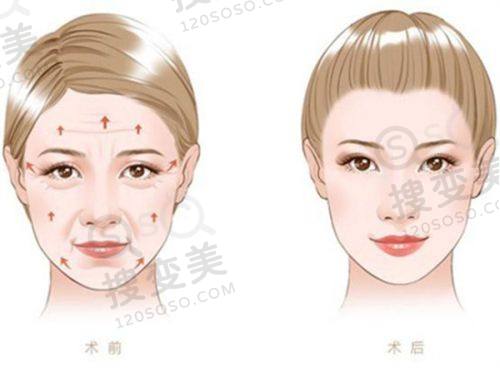 上海幼态脸打造哪个医生好？排名前三艺星林华芬、美莱申涛、华美聂婕技术超赞