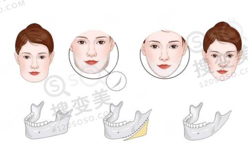 重庆松山医院双眼皮哪个医生好？段艳军精细自然，快速修复口碑好之手术优势体现