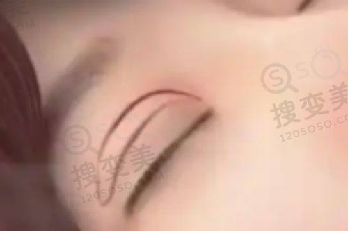 重庆松山医院院长是谁？李喆擅筋膜提升技术优、口碑好值得选——口碑评价见证实力