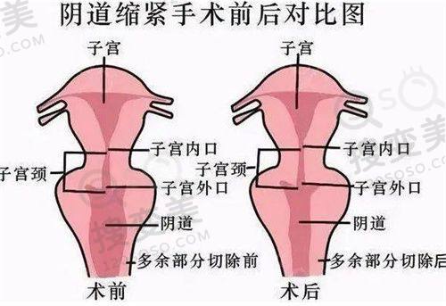 重庆松山医院眼科主事秦伟双眼皮修复好，专注眼部整形多年