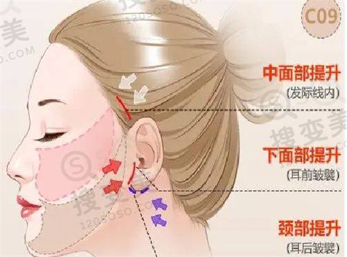 丹阳薇塔贝拉医疗美容诊所隆鼻项目价格表