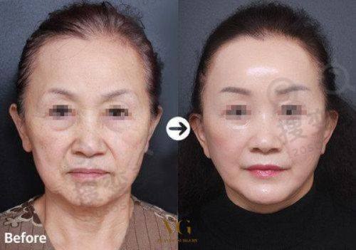 北京晶美医疗美容做双眼皮价格表之全切双眼皮价格