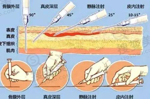 重庆松山医院减肥怎么样？重庆松山吸脂减肥手术靠谱，附医生推荐——陈石医生技术亮点