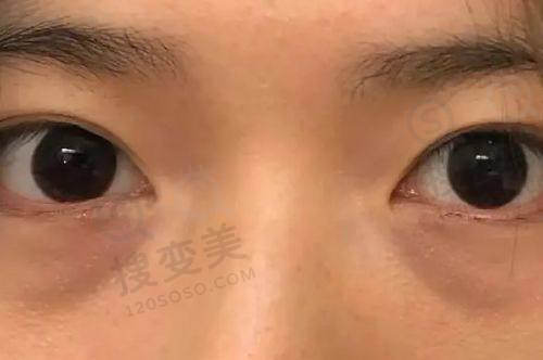 重庆松山医院磨骨手术费用是多少？肖林磨骨3.8万起，预约便捷成效好之技术优势