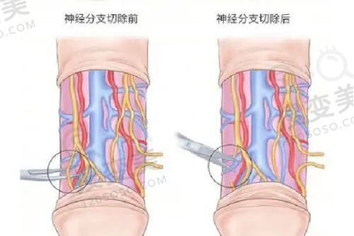 北京晶美医疗美容做双眼皮价格表之双眼皮修复价格