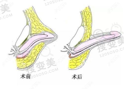 成都艾米丽医疗美容做隆鼻价格:求美者真实反馈