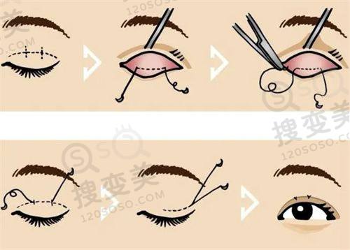 重庆松山医院隆鼻实例分享:实例成效惊艳,见证美丽蜕变