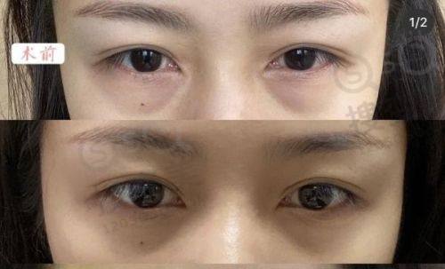 南京施尔美整形医院价格表之其他常见项目