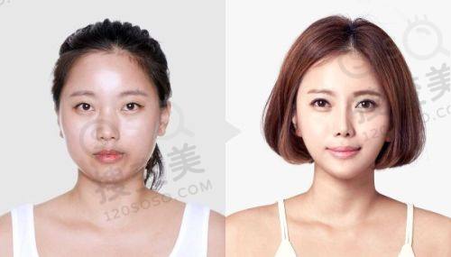 北京晶美医疗美容做双眼皮价格表之三点微创双眼皮价格