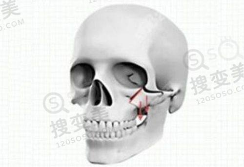 北京延世医疗美容价格表之塑形项目收费情况