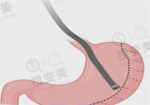 重庆松山整形医院做激光好吗？微创技术领跑，段艳军双眼皮手术自然成效获赞——段艳军双眼皮手术成效见证