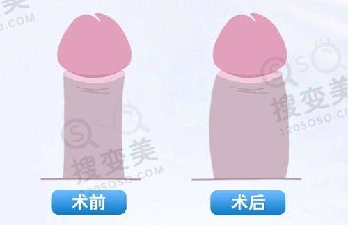 重庆松山医院隆鼻案例分享：医生技术优、价格合理，段艳军鼻整形口碑佳效果好