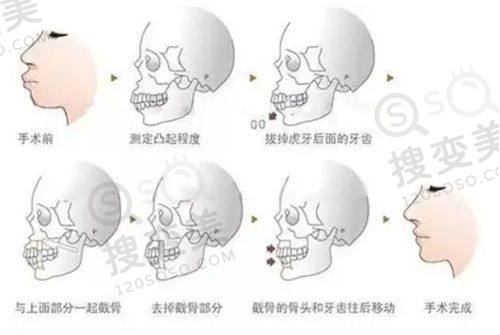 重庆松山医院隆鼻多少钱?肋软骨隆鼻技术好创伤小,价格23000 - 47000元——肋软骨隆鼻价格分析