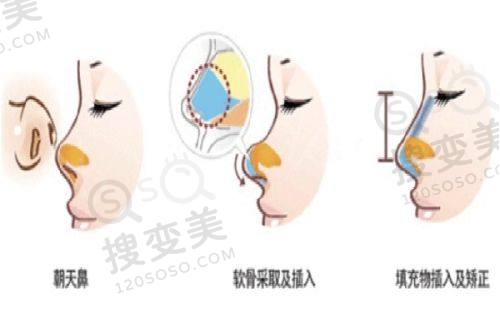 丹阳薇塔贝拉医疗美容诊所价格表,含双眼皮/隆鼻/丰胸收费及口碑评价