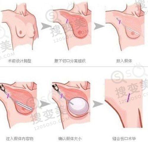 重庆松山整形医院吸脂价格揭秘!徐铎精细吸脂技术优,口碑好——选择徐铎医生的理由