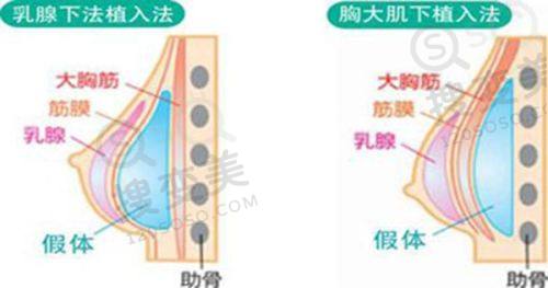 浙江艾博医疗美容门隆胸价格揭秘!含多类手术收费及医院口碑评价
