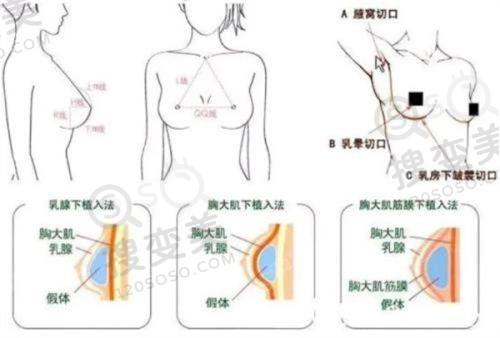 重庆松山医院正颌手术费用是多少?肖林等医生技术优,价格12w起——肖林医生技术优势与实例