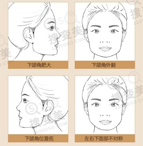 常州星空医疗美容做隆鼻价格——不同隆鼻方式价格