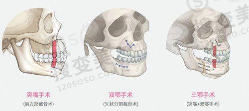 重庆松山医院双眼皮修复价格多少?段艳军微创精细,案例见证自然美眼奇迹
