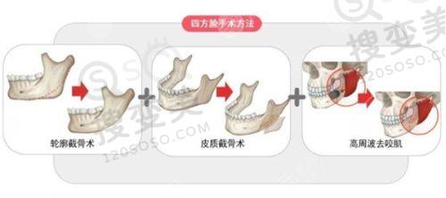 重庆松山医院口腔科怎么样？医生团队强技术好，收费透明口碑佳可放心约——正畸正颌技术亮点