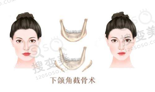 北京做双眼皮价格之北京美憬整形医院