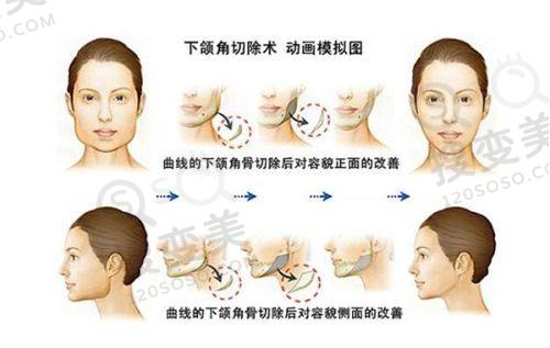 北京朵云汇医疗美容价格表之隆胸整形项目