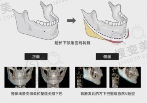 重庆松山医院双眼皮修复怎么样?真实实例/价格分享之苟磊医生