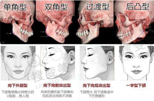 成都武侯果美医疗美容做吸脂价格表,吸脂技术成熟效果好,真人案例见证神奇蜕变
