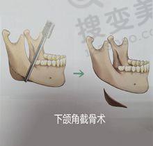 重庆松山医院正颌磨骨手术怎么样?技术有保护