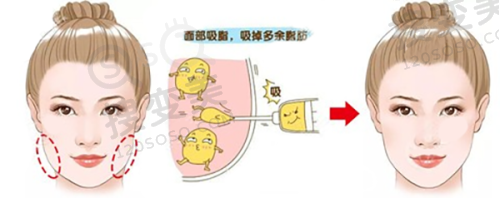 重庆松山肖林做正颌怎么样？20年经验技术优，价格亲民口碑佳之技术优势