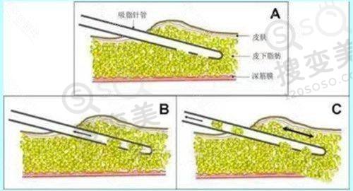 重庆松山医院何军坐诊时间表2025全新版+隆鼻技术优势价格表，速戳收藏!——鼻整形价格大公开