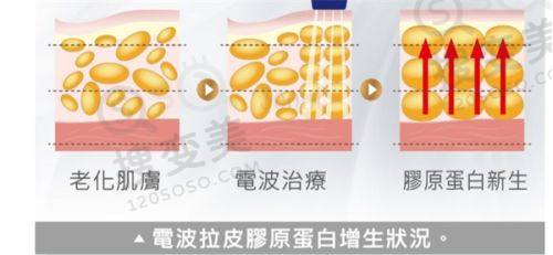 重庆肖林下颌角手术怎么样？3D技术打造自然脸，真人实例见证神奇成效之真人实例