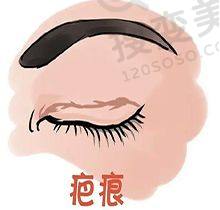 重庆松山何军双眼皮实例惊艳，价格也不贵只要4650元起——实例展示