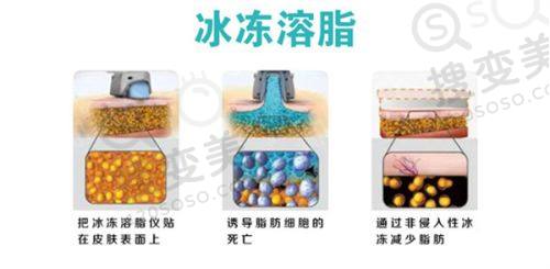 重庆松山医院隆鼻价格如何?段艳军45°高定鼻雕术效果佳获患者好评