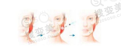 重庆松山医院双眼皮修复价格多少?段艳军服务贴心,全程关怀患者