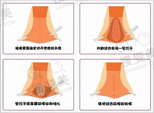 北京赵玉明医疗美容价格表之皮肤美容项目