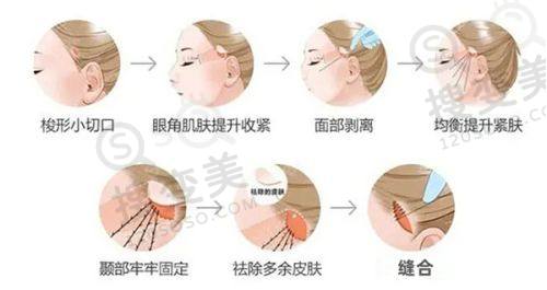 成都中优立美医疗美容价格表之隆鼻项目