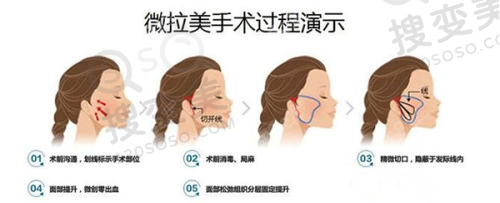 成都艾米丽医疗美容做隆鼻价格:潘红伟医生技术优势