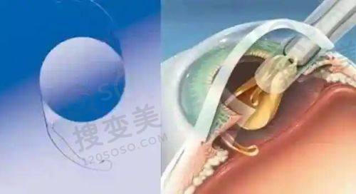 北京做双眼皮价格多少?北京八大处/泛美/美憬等医院收费大揭秘