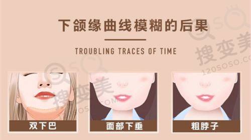 任丘市普济医疗美容双眼皮价格之双眼皮修复手术