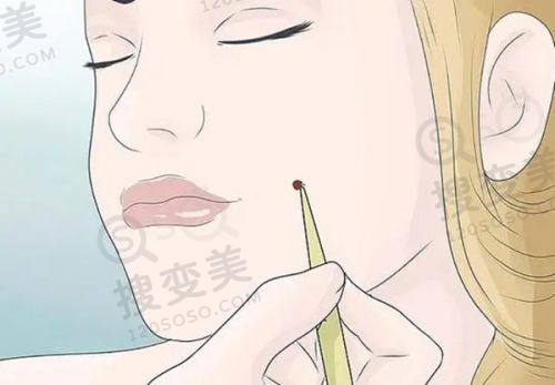 重庆松山医院双眼皮手术谁做的更好?段艳军技术优成效好口碑赞之双眼皮手术技术特色