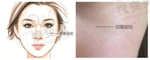 重庆松山医院双眼皮修复价格多少?段艳军实例成效好,口碑见证实力