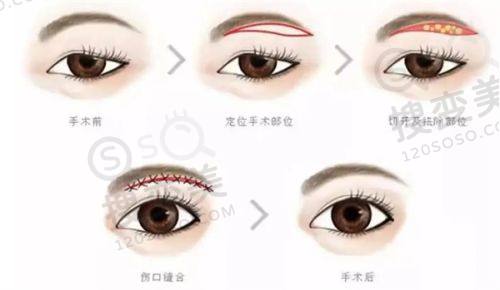 重庆松山医院隆鼻怎么样?段艳军技术优,真人实例成效好——审美与个性化设计