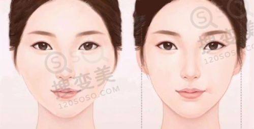 重庆肖林下颌角手术怎么样？3D技术打造自然脸，真人实例见证神奇成效之价格与套餐