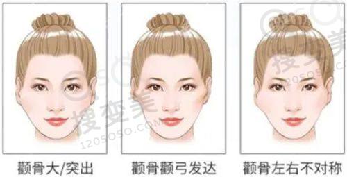 重庆肖林下颌角手术怎么样？3D技术打造自然脸，真人实例见证神奇成效之挂号与护理