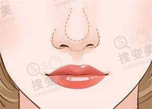 岳阳普瑞缇医疗美容门做隆鼻价格表之影响价格因素